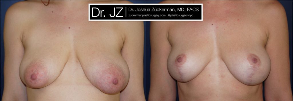 Breast lift (mastopexy) by Dr. Zuckerman. Patient, female, 2 years postop. Vertical breast lift. frontal