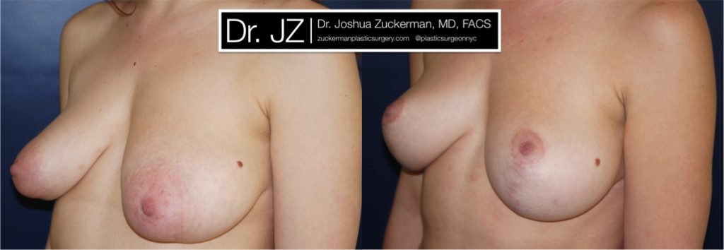 Breast lift (mastopexy) by Dr. Zuckerman. Patient, female, 2 years postop. Vertical breast lift. left oblique