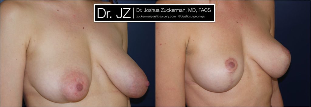 Breast lift (mastopexy) by Dr. Zuckerman. Patient, female, 2 years postop. Vertical breast lift. right oblique