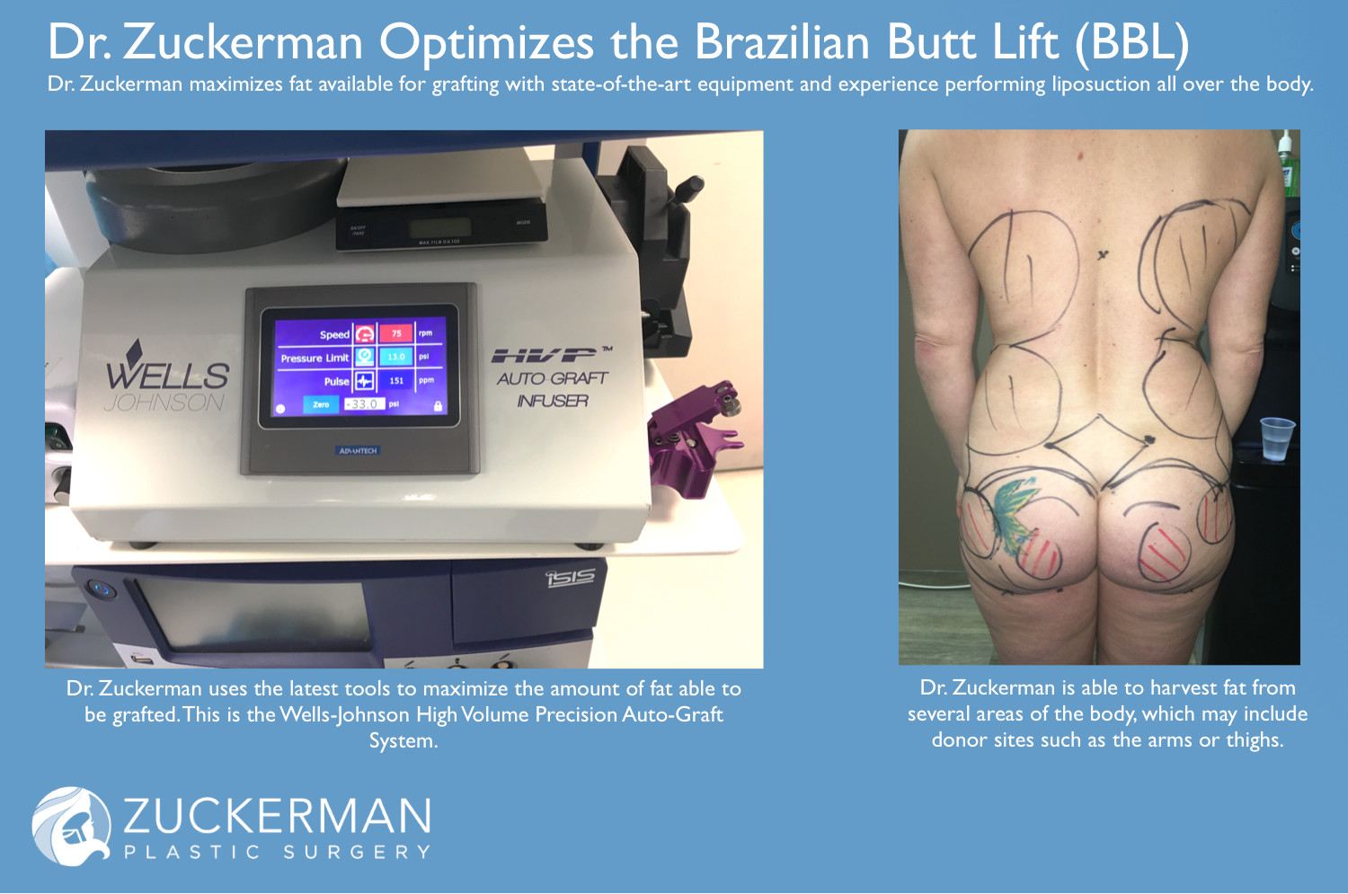 buttock augmentation brazilian butt lift maximize fat grafting