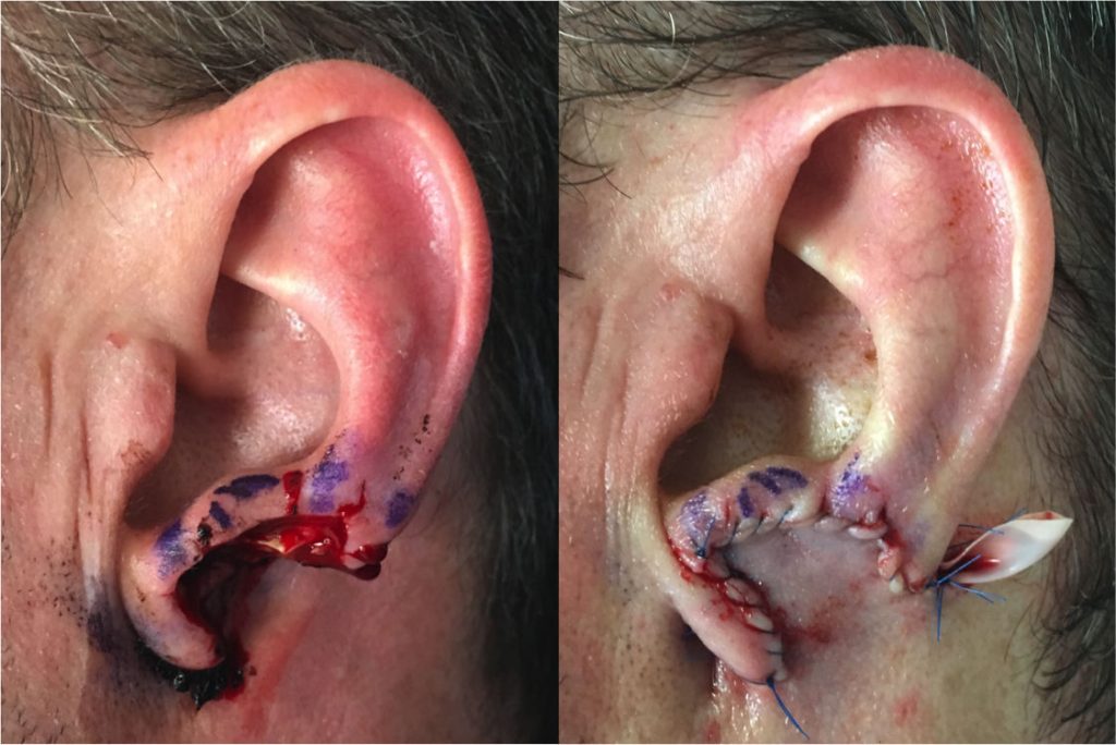 Two-stage ear lobe reconstruction by Dr. Zuckerman. In initial stage, ear lobe defect is covered with a flap from behind the ear. Six weeks later, the flap is detached and the ear lobe constructed. 3 months postop.