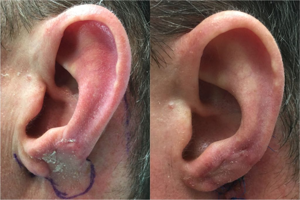 Two-stage ear lobe reconstruction by Dr. Zuckerman. In initial stage, ear lobe defect is covered with a flap from behind the ear. Six weeks later, the flap is detached and the ear lobe constructed. 3 months postop.