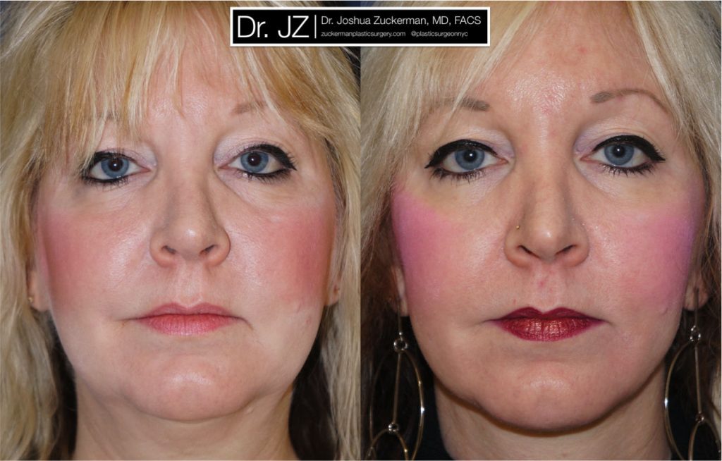 Facelift surgery by Dr. Zuckerman. Patient, female, 1 year postop. Submental liposuction (of the neck) also performed. frontal