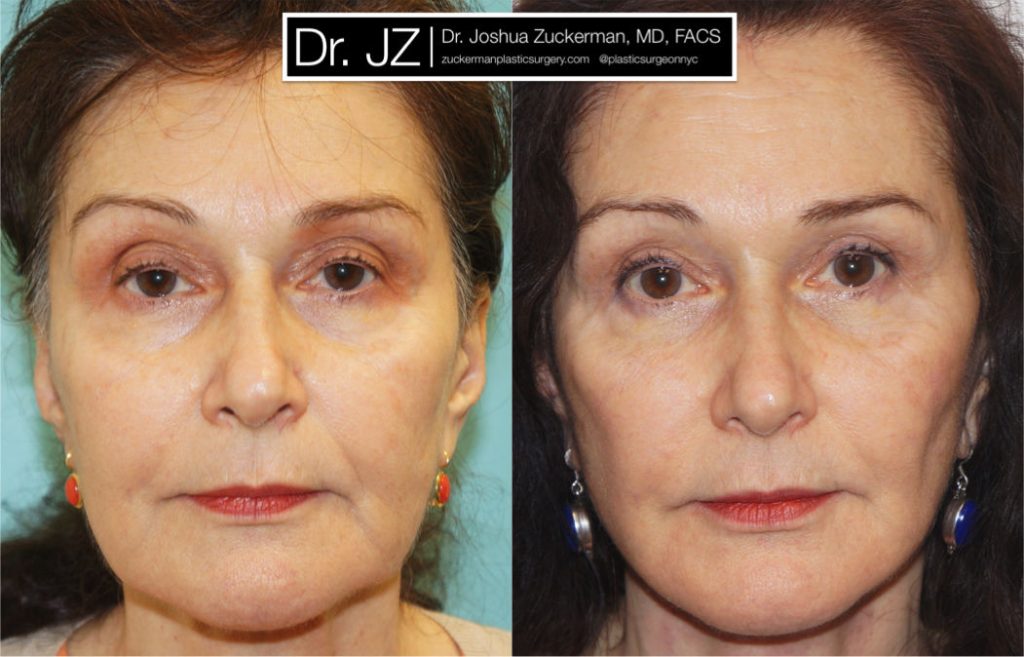 Facelift surgery by Dr. Zuckerman. patient, female, 2 months postop. Upper blepharoplasty (eyelid surgery), fat grafting to lower lids and tear troughs. TCA Peel perioral (around the mouth) for fine lines. frontal