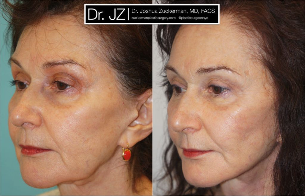 Facelift surgery by Dr. Zuckerman. patient, female, 2 months postop. Upper blepharoplasty (eyelid surgery), fat grafting to lower lids and tear troughs. TCA Peel perioral (around the mouth) for fine lines. left oblique