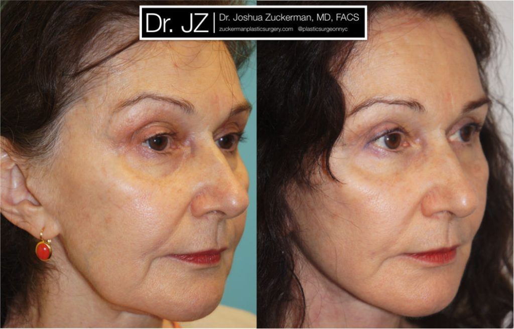 Facelift surgery by Dr. Zuckerman. patient, female, 2 months postop. Upper blepharoplasty (eyelid surgery), fat grafting to lower lids and tear troughs. TCA Peel perioral (around the mouth) for fine lines. right oblique