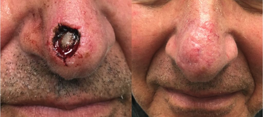 Facial reconstruction of a nasal tip defect after Moh’s excision of basal cell carcinoma, using bilobe flap by Dr. Zuckerman. 3 months postop.