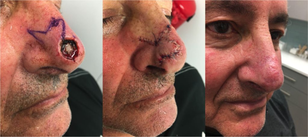 Facial reconstruction of a nasal tip defect after Moh’s excision of basal cell carcinoma, using bilobe flap by Dr. Zuckerman. 3 months postop.