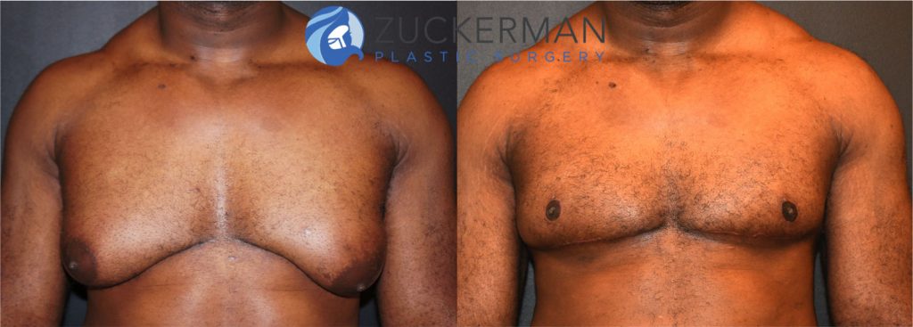 Male breast reduction (Gynecomastia correction surgery) by Dr. Zuckerman. Patient, male, 2 months postop. frontal