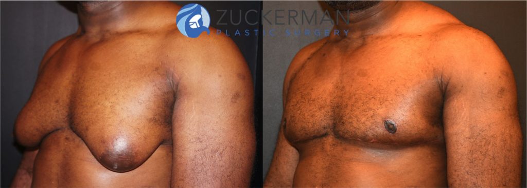 Male breast reduction (Gynecomastia correction surgery) by Dr. Zuckerman. Patient, male, 2 months postop. left oblique