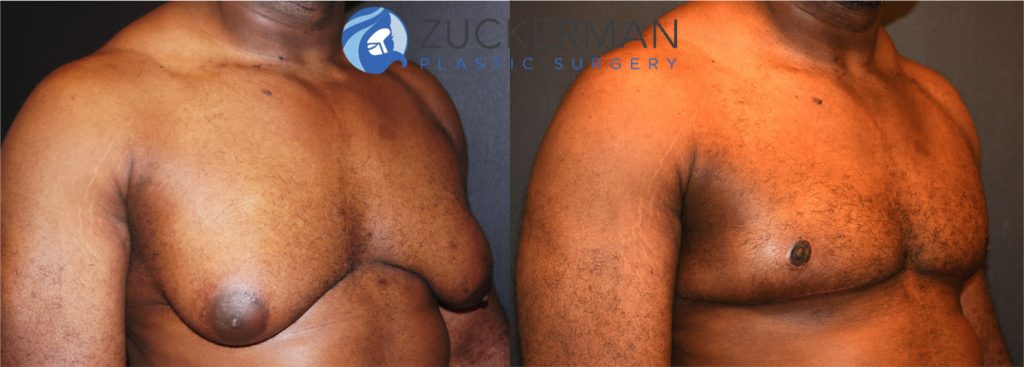 Male breast reduction (Gynecomastia correction surgery) by Dr. Zuckerman. Patient, male, 2 months postop. right oblique