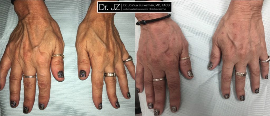 Hand rejuventation using Radiesse by Dr. Zuckerman. Patient, female, day of treatment. Reduces the prominence of aging metacarpal bonds, tendons and veins caused by aging. (Note: lighting in the after image has been slightly altered to be comparable to the before image.) frontal