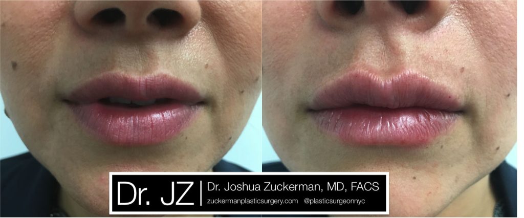 Lip augmentation by Dr. Zuckerman. Patient, female, day of treatment. Injected 0.7cc of Juvederm Ultra Plus for suble lip augmentation, accentuated philtral columns. frontal