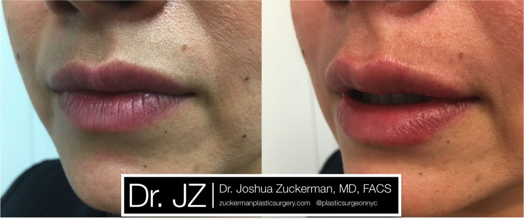 Lip augmentation by Dr. Zuckerman. Patient, female, day of treatment. Injected 0.7cc of Juvederm Ultra Plus for suble lip augmentation, accentuated philtral columns. left oblique