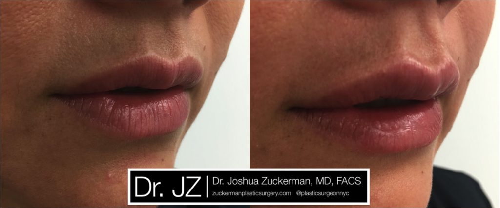 Lip augmentation by Dr. Zuckerman. Patient, female, day of treatment. Injected 0.7cc of Juvederm Ultra Plus for suble lip augmentation, accentuated philtral columns. right oblique