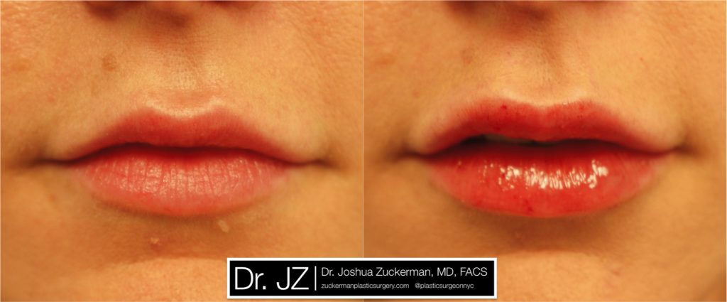 Lip augmentation by Dr. Zuckerman. Patient, female, day of treatment. Injected 0.8cc of Juvederm Ultra Plus. frontal