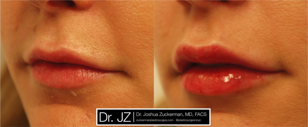 Lip augmentation by Dr. Zuckerman. Patient, female, day of treatment. Injected 0.8cc of Juvederm Ultra Plus. left oblique