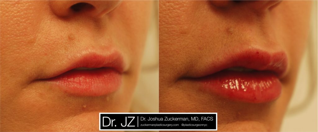 Lip augmentation by Dr. Zuckerman. Patient, female, day of treatment. Injected 0.8cc of Juvederm Ultra Plus. right oblique