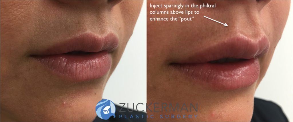 A before and after of lip augmentation by Dr. Zuckerman with the philtral column injection technique, which produces a subtle upturn in the upper lip to enhance the patient’s “pout”.