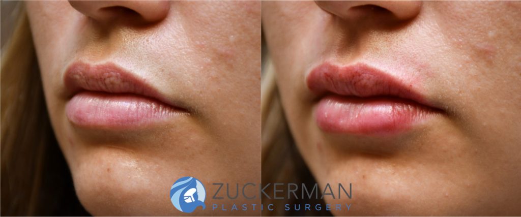 Lip augmentation by Dr. Zuckerman before and after image. Patient pictured before treatment and immediately after. Patient desired a subtle augmentation, and Dr. Zuckerman injected 0.5cc of Volbella.