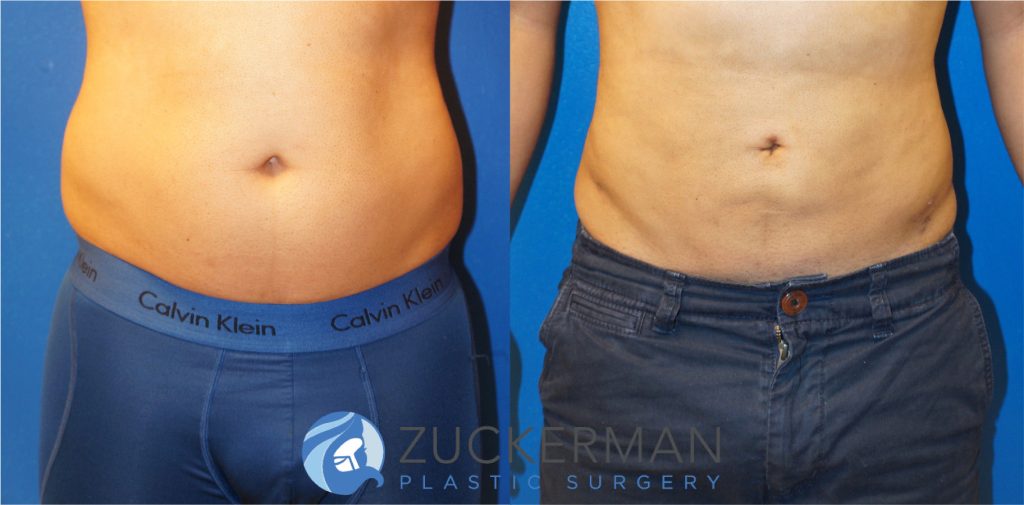 Liposuction of the abdomen and flanks by Dr. Zuckerman. Patient, male, 1.5 months postop (contours will continue to improve and smooth). Approximately 1.5 liters of fat removed. frontal