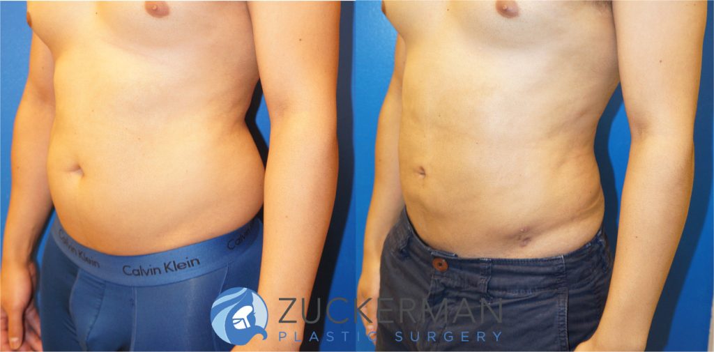 Liposuction of the abdomen and flanks by Dr. Zuckerman. Patient, male, 1.5 months postop (contours will continue to improve and smooth). Approximately 1.5 liters of fat removed. left oblique