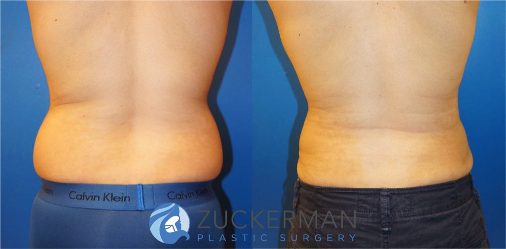 Liposuction of the abdomen and flanks by Dr. Zuckerman. Patient, male, 1.5 months postop (contours will continue to improve and smooth). Approximately 1.5 liters of fat removed. posterior