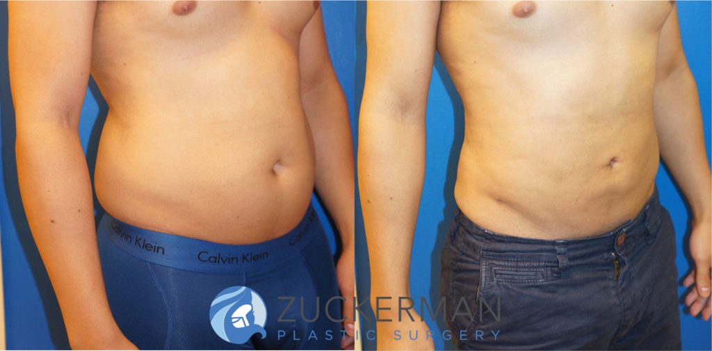 Liposuction of the abdomen and flanks by Dr. Zuckerman. Patient, male, 1.5 months postop (contours will continue to improve and smooth). Approximately 1.5 liters of fat removed. right oblique