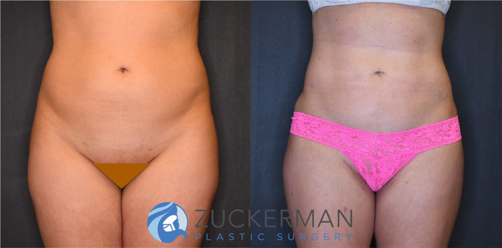 Liposuction of the abdomen, flanks, and lower back by Dr. Zuckerman. Patient, female, 3 months postop. Approximately 2 liters of fat removed. Fat grafting to the buttocks also performed. frontal