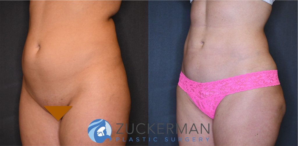 Liposuction of the abdomen, flanks, and lower back by Dr. Zuckerman. Patient, female, 3 months postop. Approximately 2 liters of fat removed. Fat grafting to the buttocks also performed. left oblique