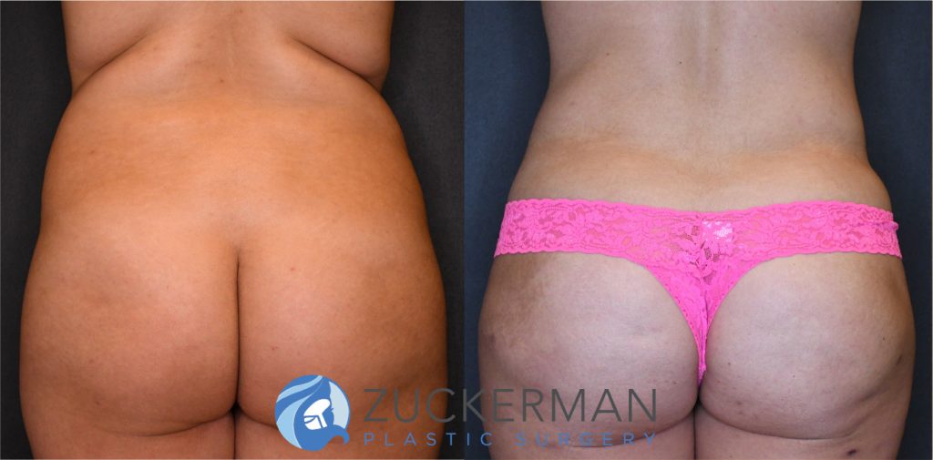 Liposuction of the abdomen, flanks, and lower back by Dr. Zuckerman. Patient, female, 3 months postop. Approximately 2 liters of fat removed. Fat grafting to the buttocks also performed. posterior