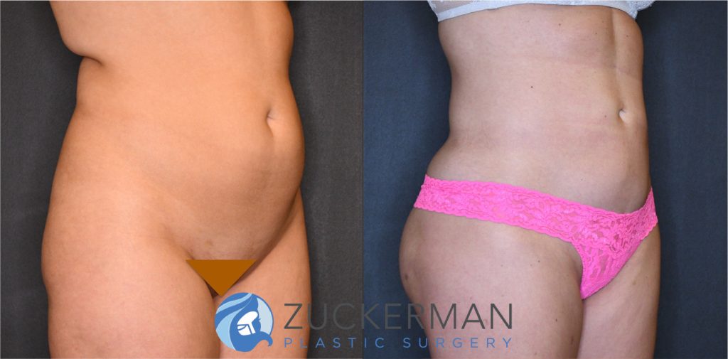 Liposuction of the abdomen, flanks, and lower back by Dr. Zuckerman. Patient, female, 3 months postop. Approximately 2 liters of fat removed. Fat grafting to the buttocks also performed. right oblique