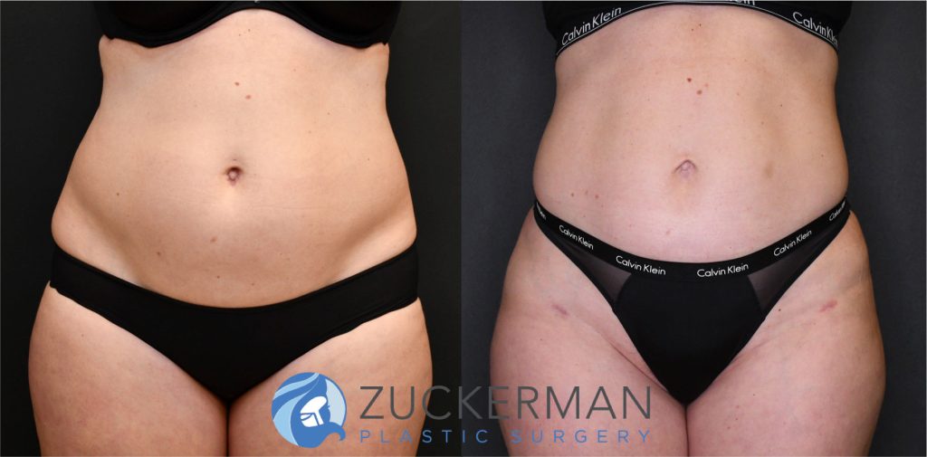 Liposuction of the abdomen, flanks, and lower back by Dr. Zuckerman. Patient, female, 3 months postop. Approximately 2 liters of fat removed. Fat grafting to the buttocks also performed. frontal