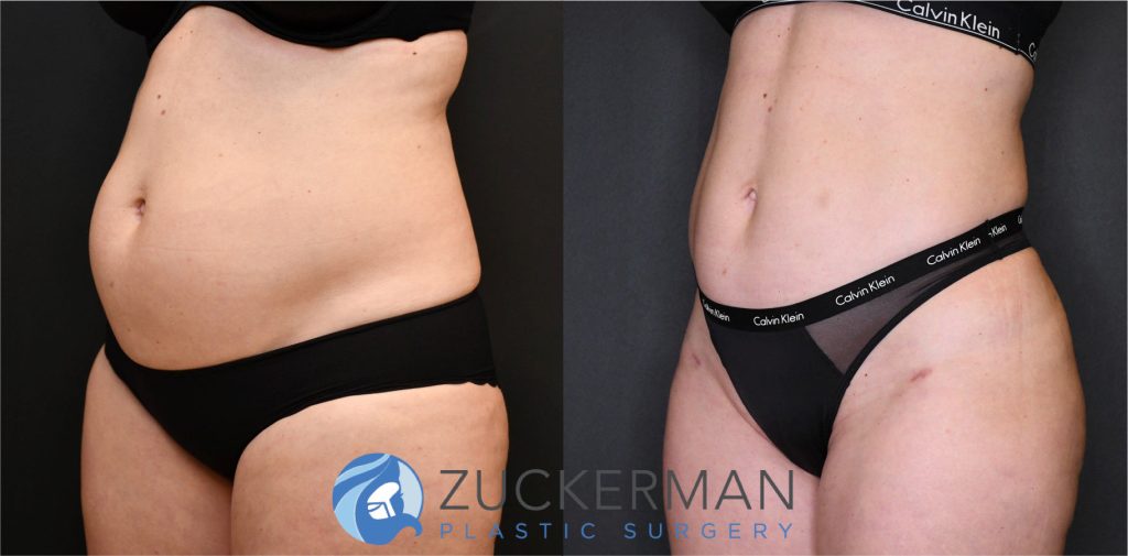 Liposuction of the abdomen, flanks, and lower back by Dr. Zuckerman. Patient, female, 3 months postop. Approximately 2 liters of fat removed. Fat grafting to the buttocks also performed. left oblique