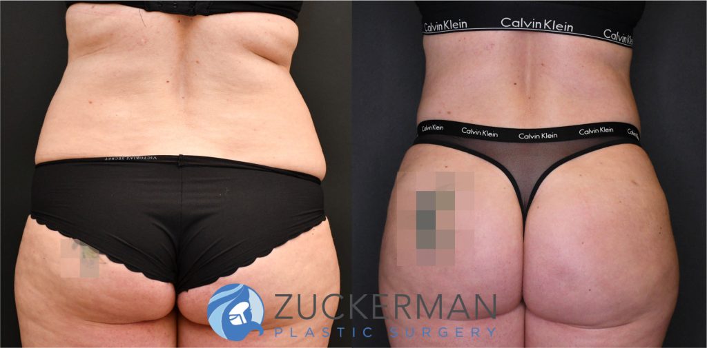 Liposuction of the abdomen, flanks, and lower back by Dr. Zuckerman. Patient, female, 3 months postop. Approximately 2 liters of fat removed. Fat grafting to the buttocks also performed. posterior