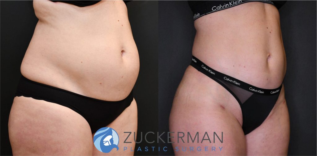 Liposuction of the abdomen, flanks, and lower back by Dr. Zuckerman. Patient, female, 3 months postop. Approximately 2 liters of fat removed. Fat grafting to the buttocks also performed. right oblique