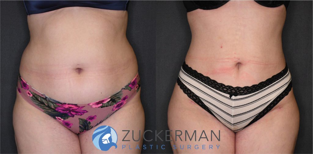 Liposuction of the abdomen, flanks, and lower back by Dr. Zuckerman. Patient, female, 3 months postop. Approximately 4 liters of fat removed. Fat grafting to the buttocks also performed. frontal