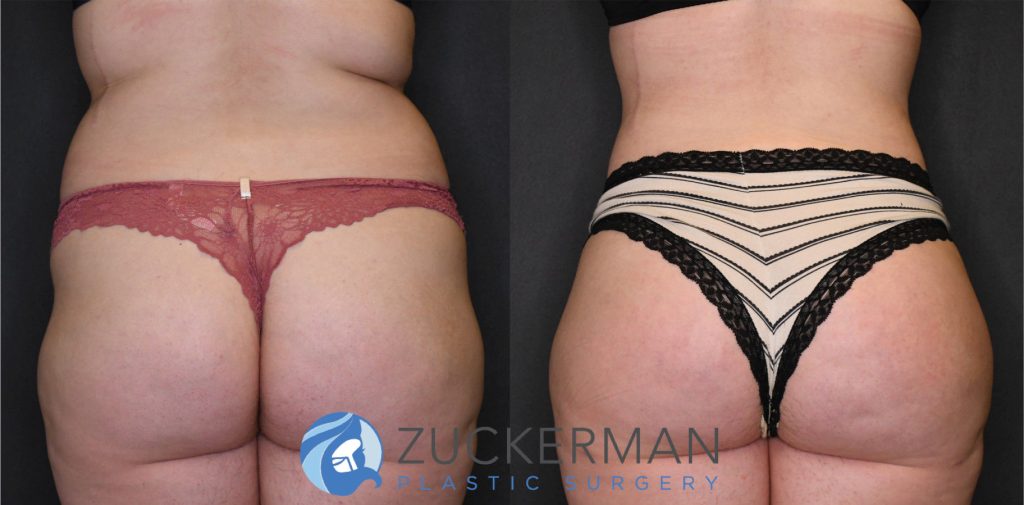 Liposuction of the abdomen, flanks, and lower back by Dr. Zuckerman. Patient, female, 3 months postop. Approximately 4 liters of fat removed. Fat grafting to the buttocks also performed. posterior