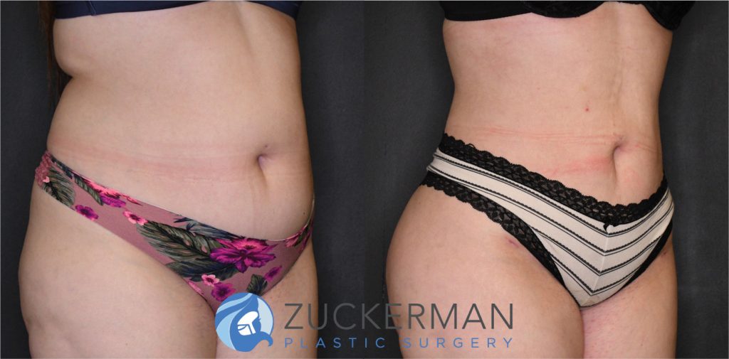 Liposuction of the abdomen, flanks, and lower back by Dr. Zuckerman. Patient, female, 3 months postop. Approximately 4 liters of fat removed. Fat grafting to the buttocks also performed. right oblique