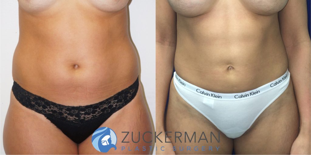 Liposuction of the abdomen, flanks, and lower back by Dr. Zuckerman. Patient, female, 6 months postop. Approximately 1 liter of fat removed. frontal