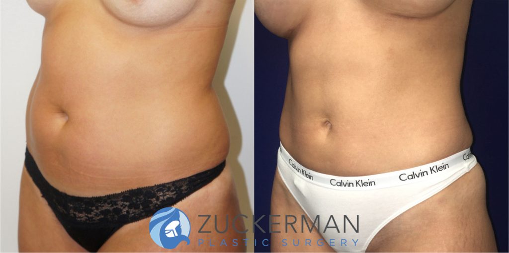 Liposuction of the abdomen, flanks, and lower back by Dr. Zuckerman. Patient, female, 6 months postop. Approximately 1 liter of fat removed. left oblique