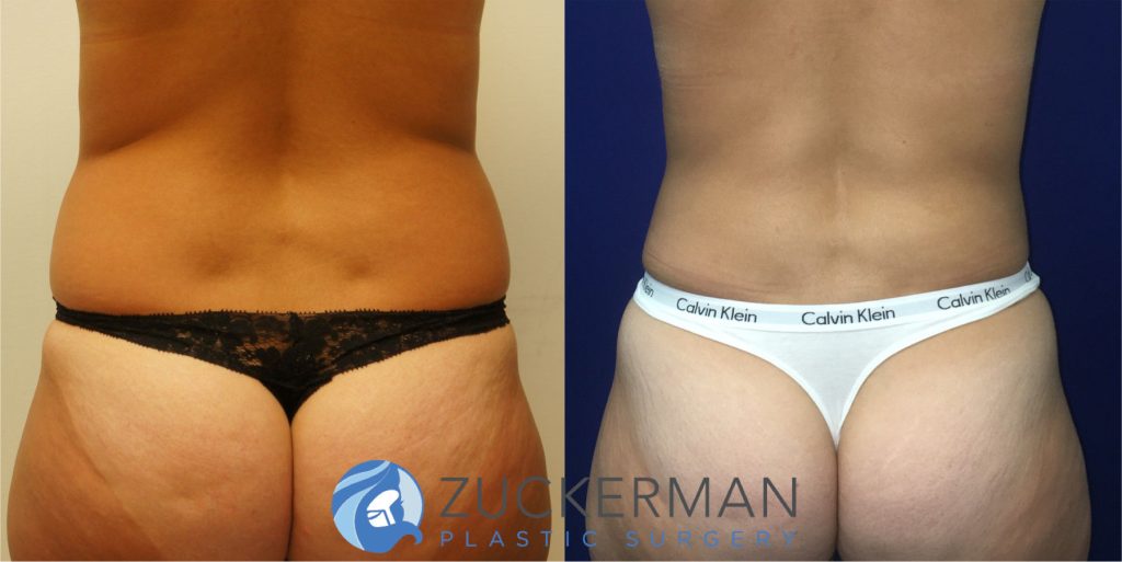 Liposuction of the abdomen, flanks, and lower back by Dr. Zuckerman. Patient, female, 6 months postop. Approximately 1 liter of fat removed. posterior