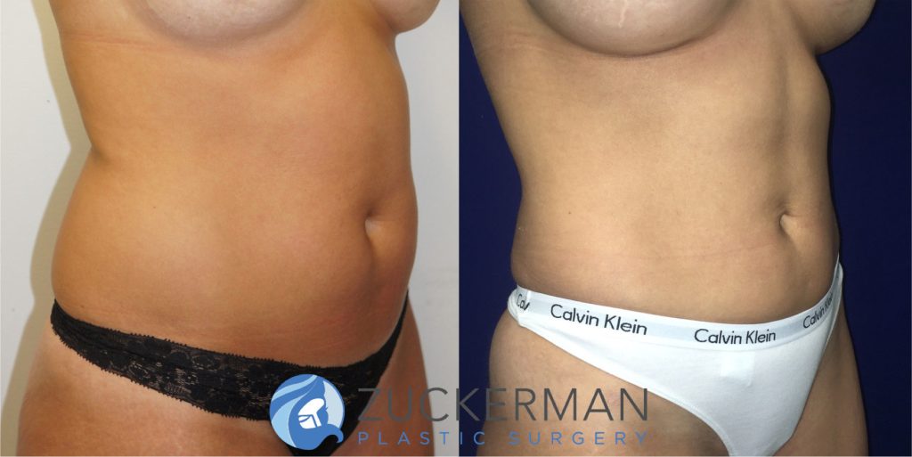 Liposuction of the abdomen, flanks, and lower back by Dr. Zuckerman. Patient, female, 6 months postop. Approximately 1 liter of fat removed. right oblique