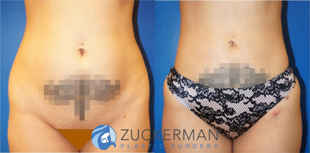 Liposuction of the abdomen and flanks by Dr. Zuckerman. Patient, female, 3 months postop. Approximately 1.5 liters of fat removed. Fat grafting to the buttocks also performed. frontal