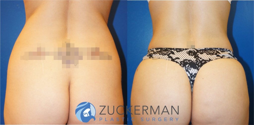 Liposuction of the abdomen and flanks by Dr. Zuckerman. Patient, female, 3 months postop. Approximately 1.5 liters of fat removed. Fat grafting to the buttocks also performed. posterior