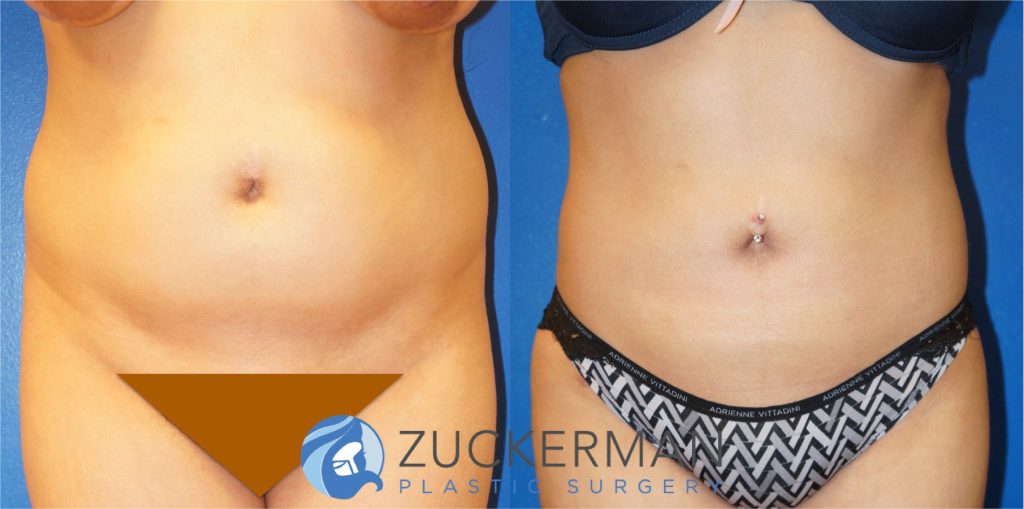 Liposuction of the abdomen, flanks, and lower back by Dr. Zuckerman. Patient, female, 2 months postop. Approximately 2 liters of fat removed. Fat grafting to the buttocks also performed. frontal 1