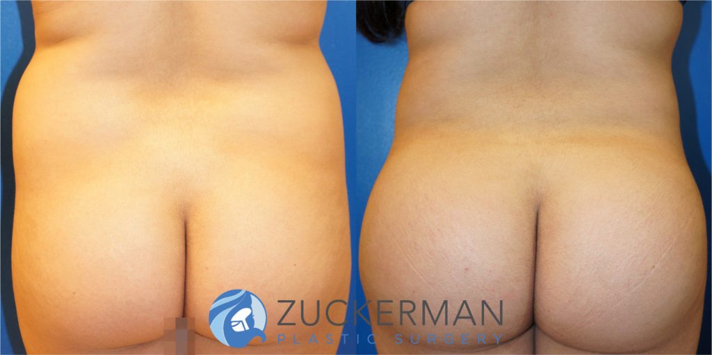 Liposuction of the abdomen, flanks, and lower back by Dr. Zuckerman. Patient, female, 2 months postop. Approximately 2 liters of fat removed. Fat grafting to the buttocks also performed. posterior 1