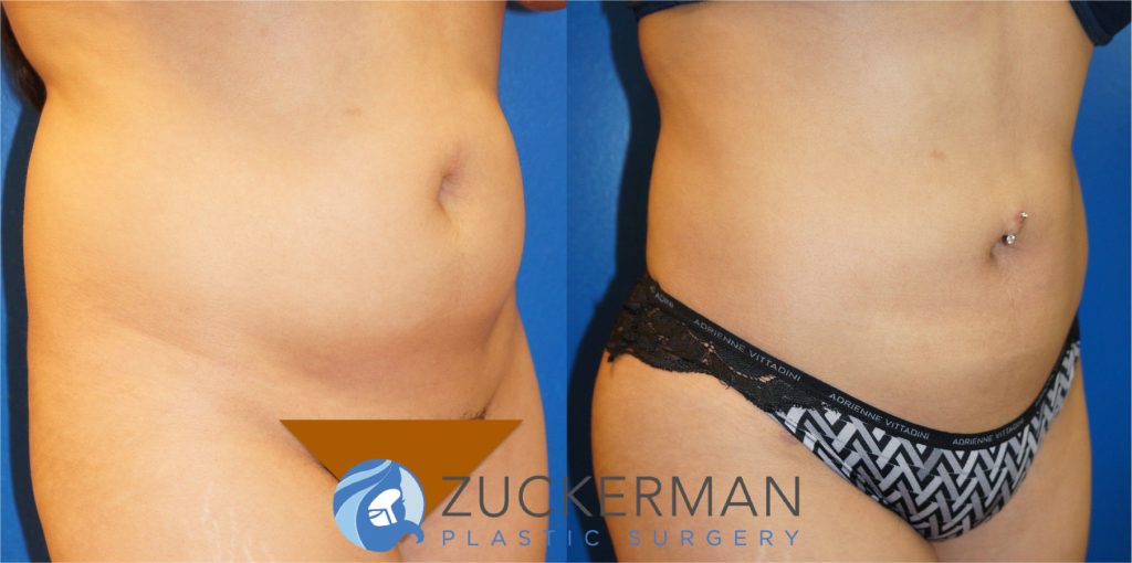 Liposuction of the abdomen, flanks, and lower back by Dr. Zuckerman. Patient, female, 2 months postop. Approximately 2 liters of fat removed. Fat grafting to the buttocks also performed. right oblique 1