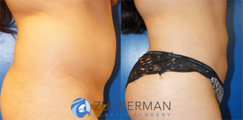 Liposuction of the abdomen, flanks, and lower back by Dr. Zuckerman. Patient, female, 2 months postop. Approximately 2 liters of fat removed. Fat grafting to the buttocks also performed. right profile 1