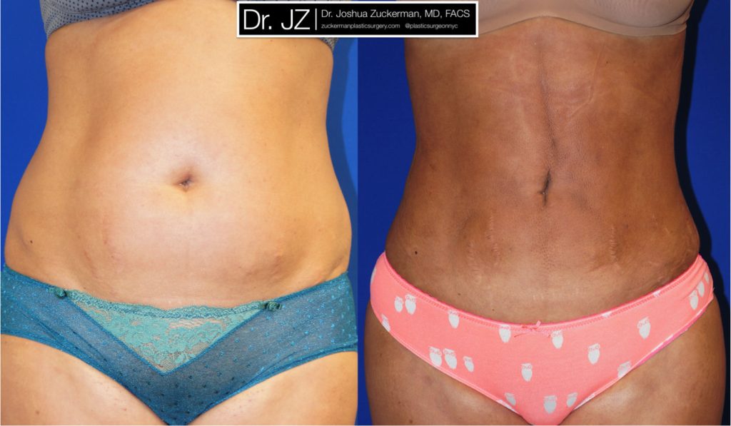 Liposuction of the abdomen, flanks, and lower back by Dr. Zuckerman. Patient, female, 1 months postop. Approximately 3.5 liters of fat removed. Fat grafting to the buttocks also performed. frontal